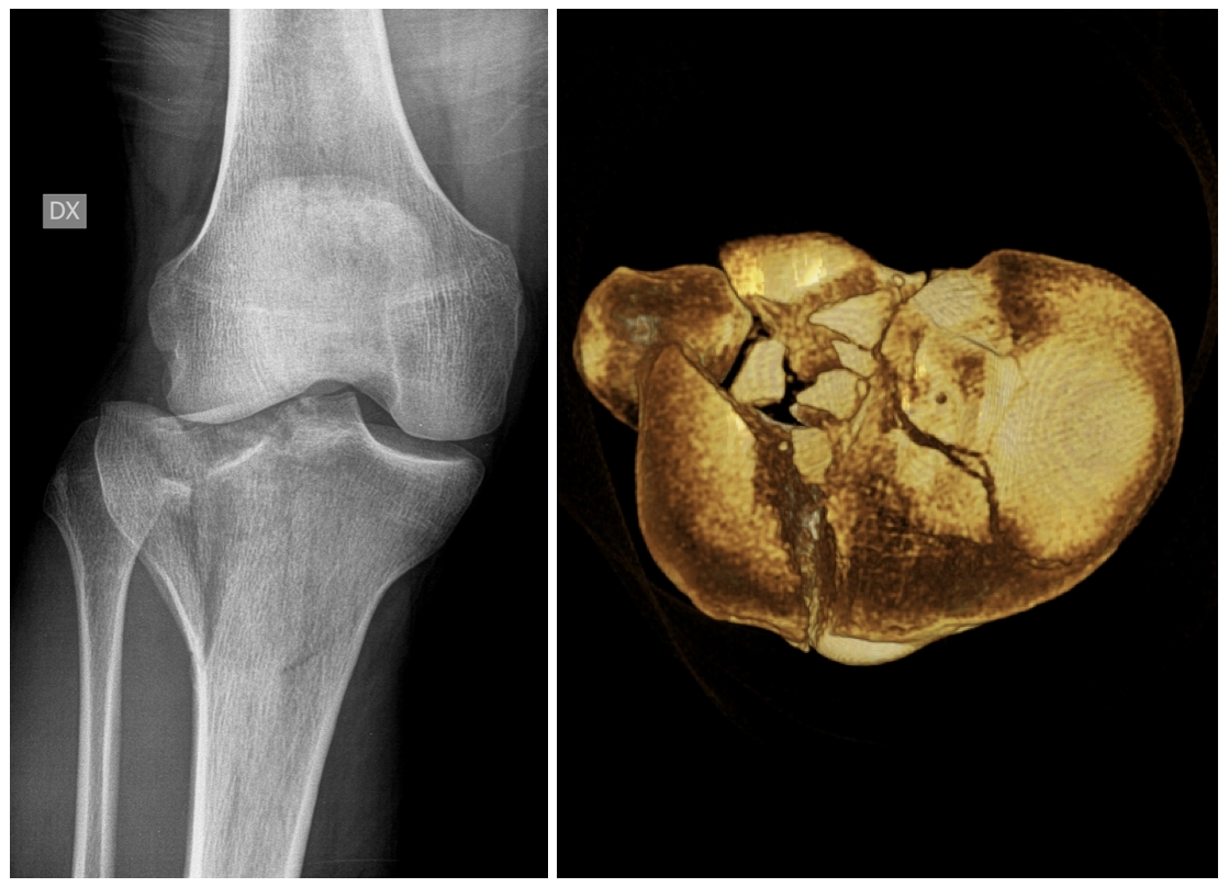 Le fratture del piatto tibiale del ginocchio - OTB ...