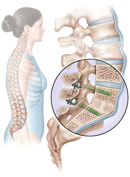 artrodesi vertebrale