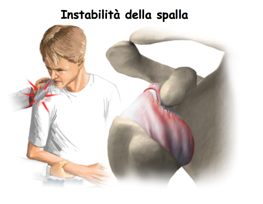 Разрыв плечевого сустава симптомы. Вывих плечевого сустава надрыв связок. Вывих плеча разрыв связок операция. Разрыв связок плечевого сустава. Растяжение и разрыв связок плечевого сустава.