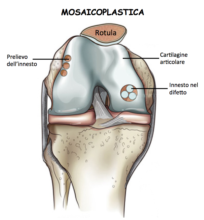 mosaicoplastica