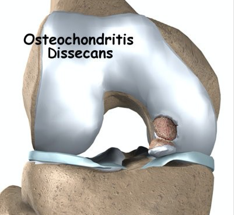 osteocondrite