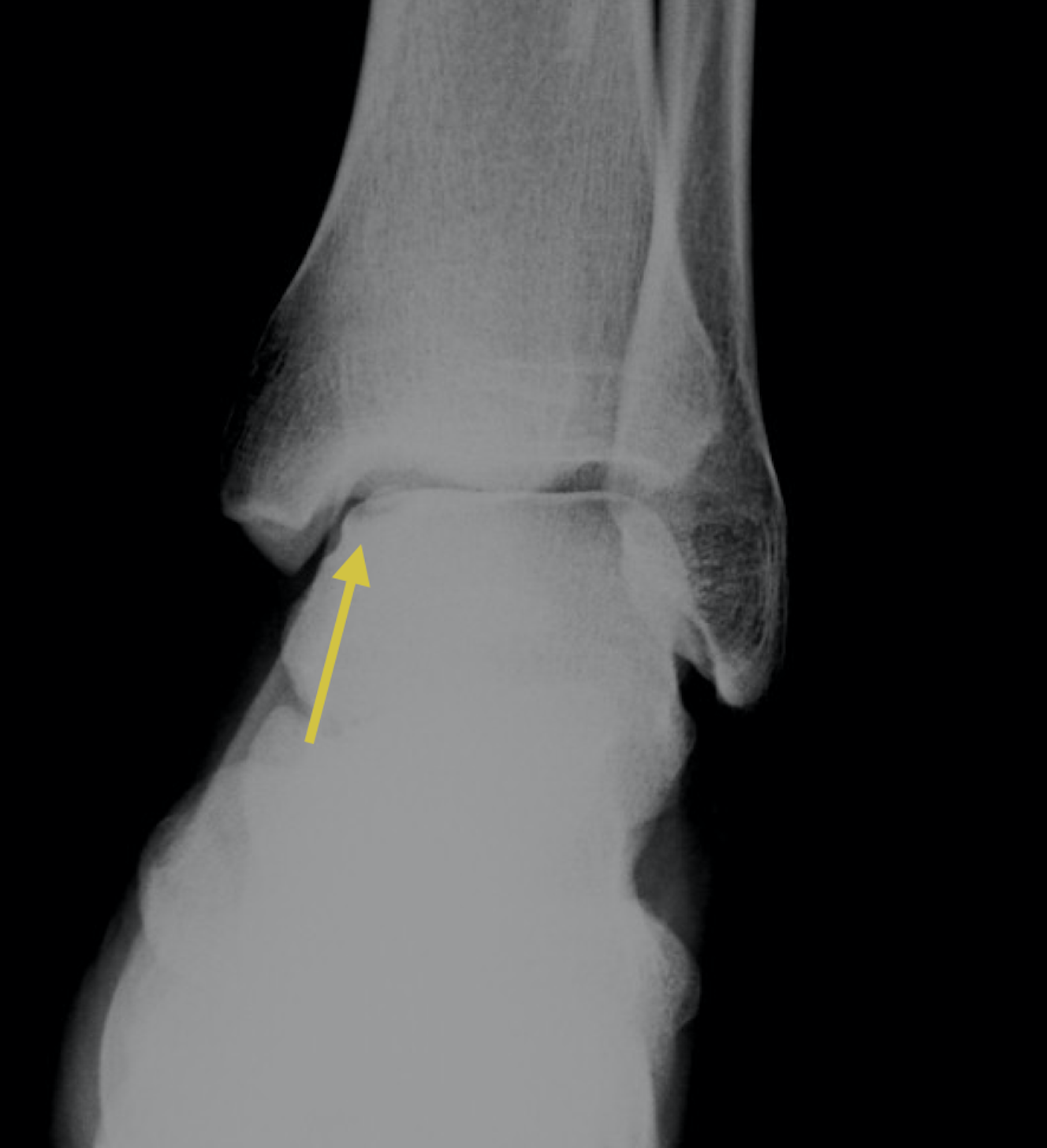 osteocondrite caviglia rx