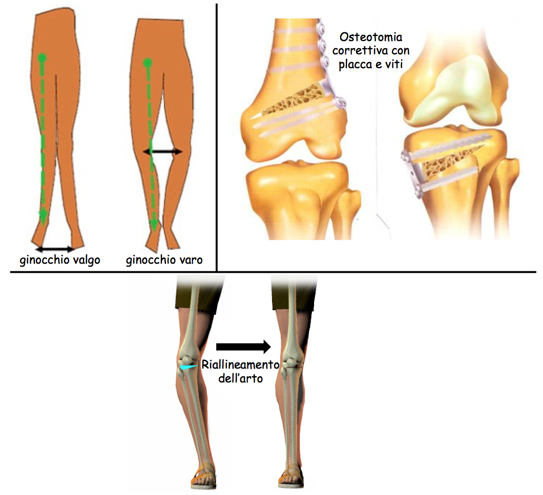 osteotomia ginocchio